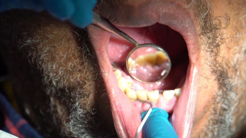 Close-up of a dental examination showing teeth and gums with a dental mirror and tool